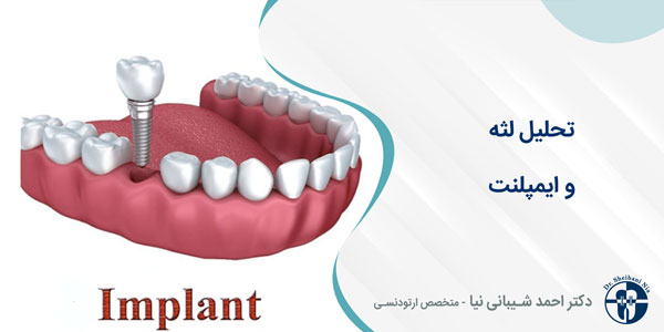 تحلیل لثه و ایمپلنت