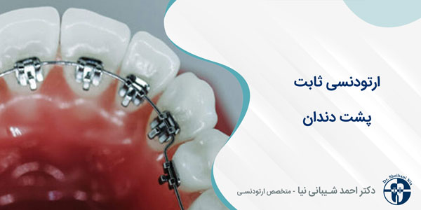 ارتودنسی ثابت پشت دندان
