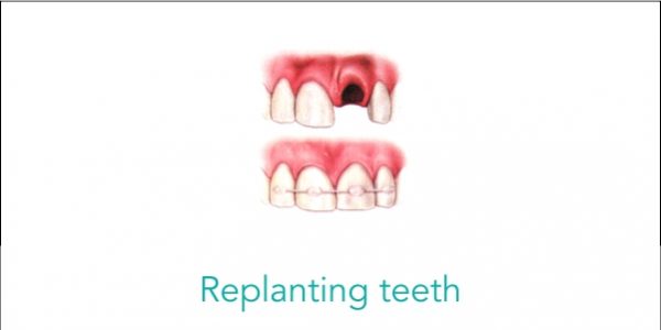 Replanting-teeth Replanting teeth