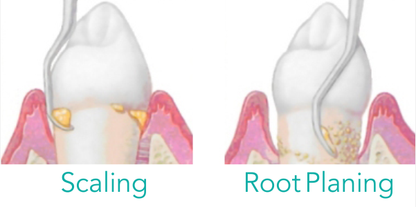 scaling root planing before and stains