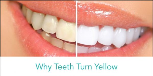 Why-teeth-turn-yellow Why teeth turn yellow