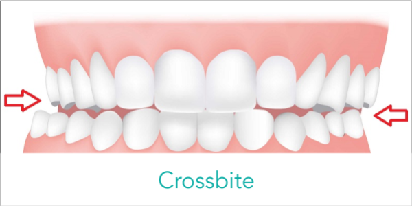 what is crossbite