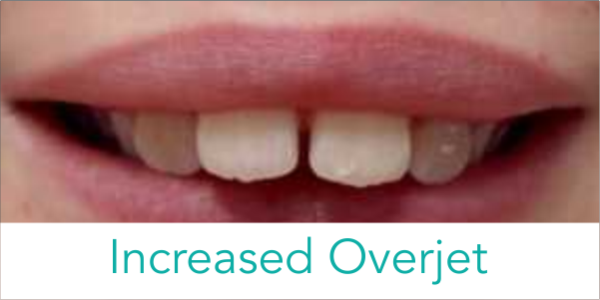 what is increased overjet