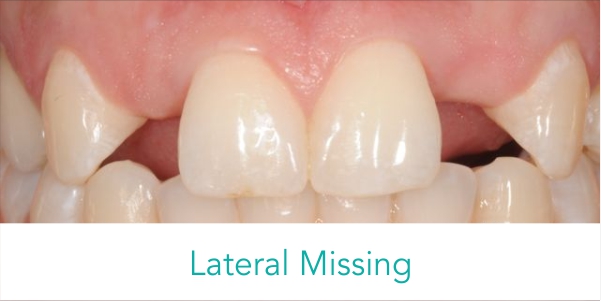 lateral missing