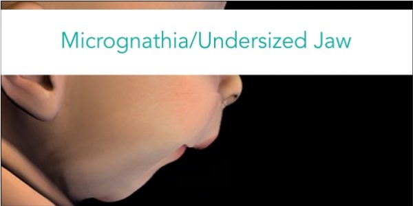 micrognathiaundersized-jaw1 micrognathia or undersized jaw