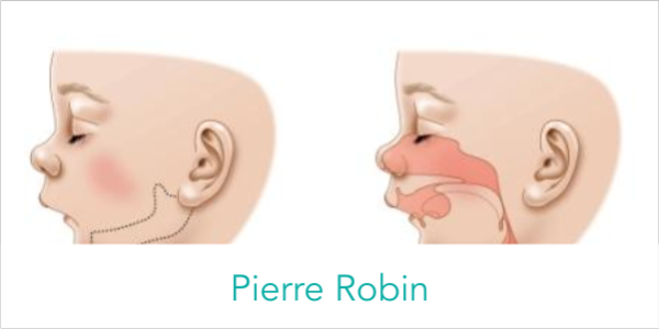 Pierre Robin