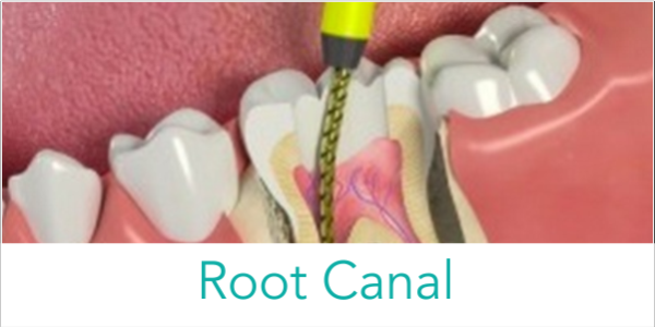 root-canal Root canal