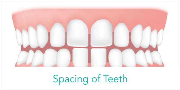 spacing of teeth