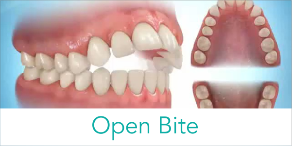 what is open bite ✔️Dr. Sheibani Nia, best orthodontist