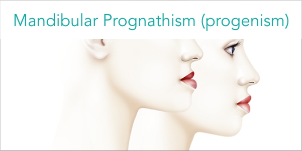 mandibular prognathism progenism