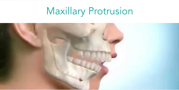 maxillary protrusion