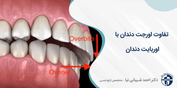 تفاوت اورجت دندان با اوربایت دندان