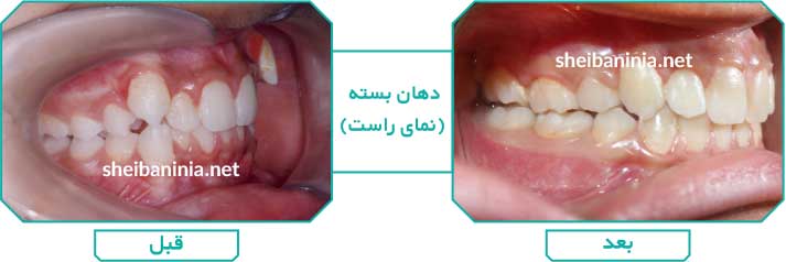 عکس قبل و بعد از ارتودنسی - کلاس 2 دندانی - بیمار یک