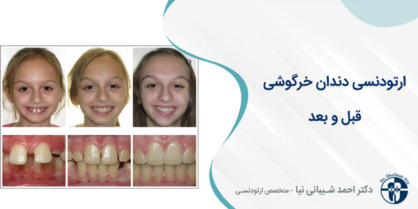 ارتودنسی دندان خرگوشی قبل و بعد