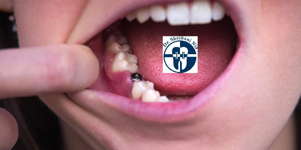 کاندید انجام ایمپلنت دندان